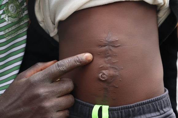 A father's hand points at the scars on his son's stomach after a surgery to remove intestinal worms.
