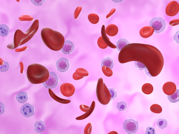 Illustration of red blood cells affected by sickle cell disease.