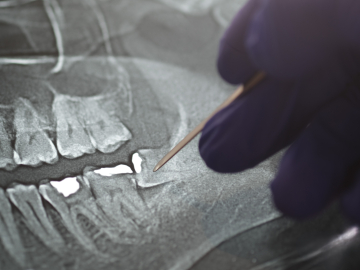 Panoramic Xray tooths showing Amalgam that used for dental restorative material