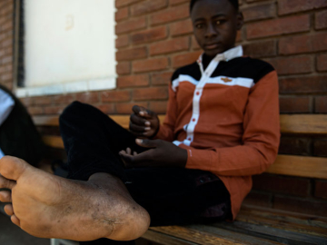 Photo of Boy with Mycetoma