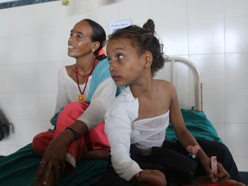 Anita Neupane following surgery on a contracture that goes from her right shoulder to her waist, which prevents her from lifting her arm.