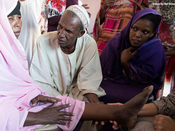 A woman's left foot is checked for mycetoma by DNDi staff in Sudan; her right leg was infected with mycetoma and had to be amputated. Image by Neil Brandvold/DNDi