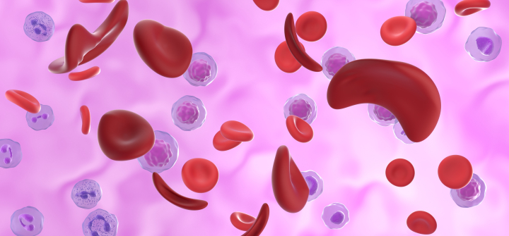 Illustration of red blood cells affected by sickle cell disease.