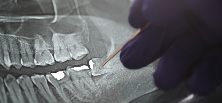 Panoramic Xray tooths showing Amalgam that used for dental restorative material 