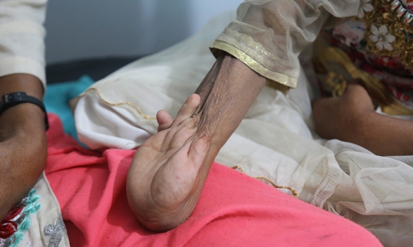 Anita, who suffered a terrible burn, prior to surgery in Nepalgunj 