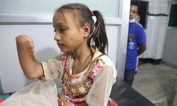 Anita, prior to surgery in Nepalgunj on a contracture that goes from her right shoulder to her waist, which prevents her from lifting her arm. 