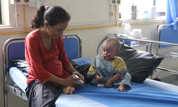 Baby recovering from a bad burn in the Nepal Cleft and Burn Center, Kirtipur (Kathmandu suburb)